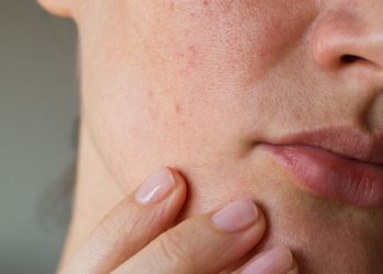 تعرف على أسباب تهيج البشرة المفاجئ..