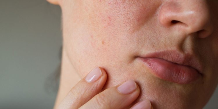 تعرف على أسباب تهيج البشرة المفاجئ..