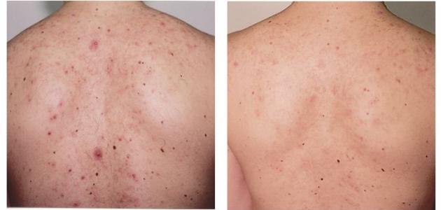 حبوب الظهر وعلاجها