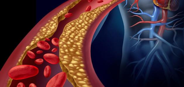 أدلة على ارتفاع الكوليسترول الضار في الدم