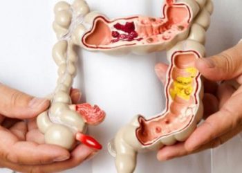 نصائح هامة لمرضى القولون العصبي