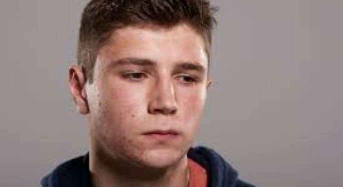 كيف يتكون حب الشباب؟