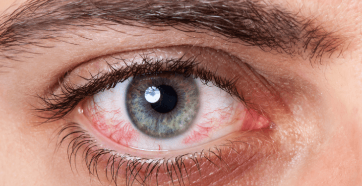 طرق علاج احمرار العين