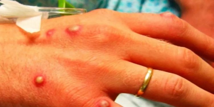 وزارة الصحة التركية تعلن دخول “جدري القرود” إلى أراضيها