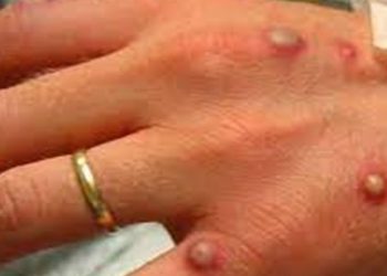 وزارة الصحة الإسرائيلية تعلن عن رصد 66 إصابة بـ”جدري القرود”