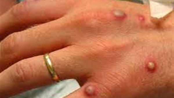 وزارة الصحة الإسرائيلية تعلن عن رصد 66 إصابة بـ”جدري القرود”