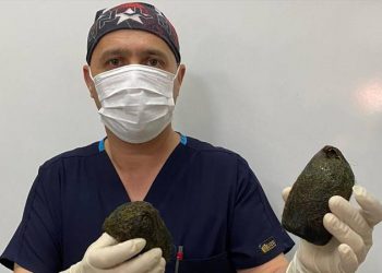 العثور على 2 كيلو غرام من الشعر داخل معدة امرأة تركية