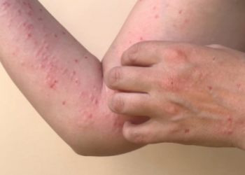 تركيا تعلن خلوَّها من “جدري القرود”