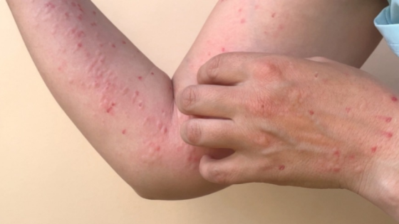 تركيا تعلن خلوَّها من “جدري القرود”