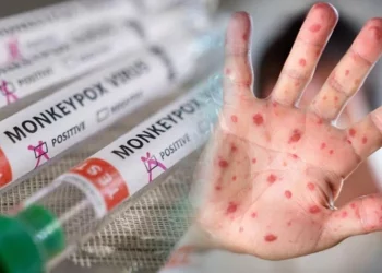 4 إصابات محتملة في أنقرة بجدري القردة