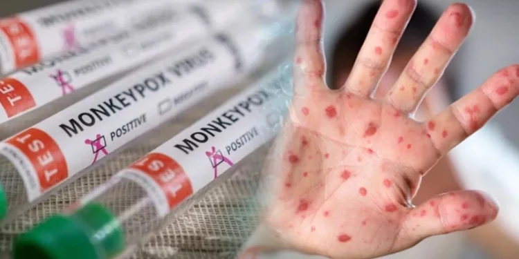 4 إصابات محتملة في أنقرة بجدري القردة