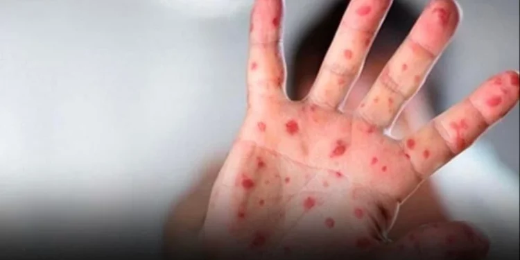 فيروس جدري الماء ينتشر بسرعة في العالم