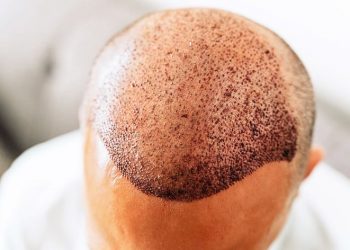 مصل يقضي على الصلع في 20 يومًا!