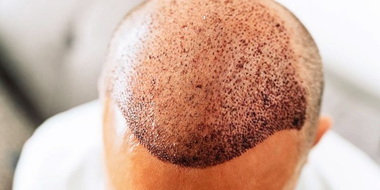 مصل يقضي على الصلع في 20 يومًا!